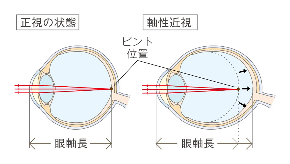 子供の近視進行